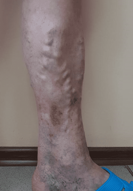 Tratamentul picioarelor eczeme în varicoză - Cum se trateaza picioarele eczeme în varicoza