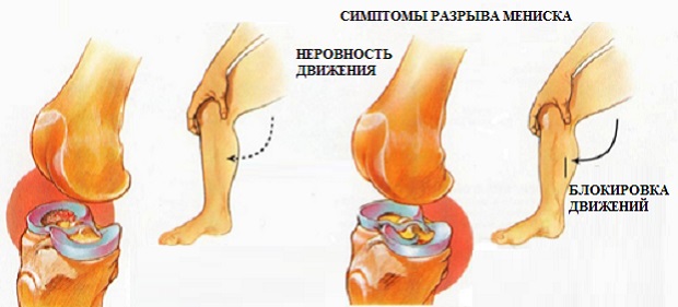 Разрыв мениска Разрыв мениска коленного сустава